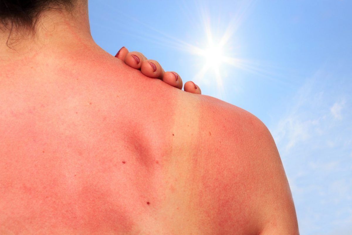 Treating a Sunburn | Health Tips | Texas ER