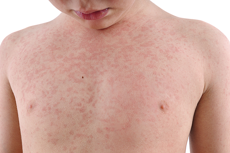 Measles: What Parents Should Know | Emergency Room in Austin, TX | Physicians Premier ER