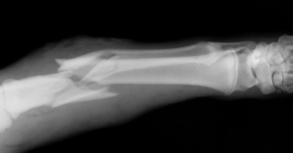Signs that You Have Broken a Bone | Austin ER | Physicians Premier